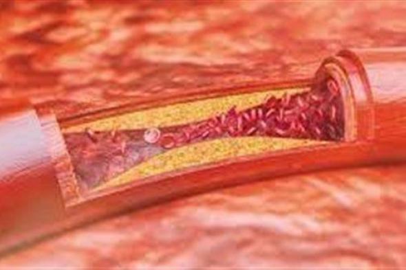 أطعمة يمكن أن "تذيب بشكل طبيعي" جلطات الدم المميتة.. تعرف عليها!