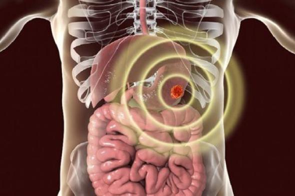 ست علامات تحذيرية لسرطان المعدة!